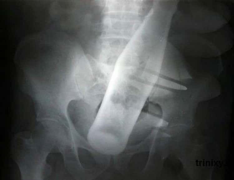 Embarrassing X Rays